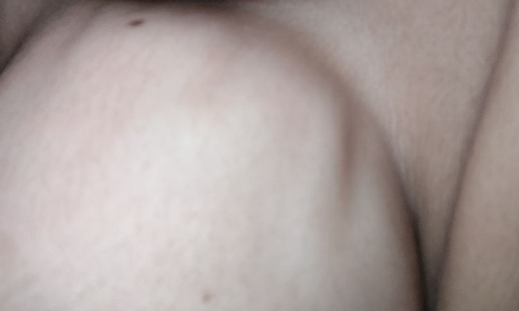 Mastopexia y rippling - 68122