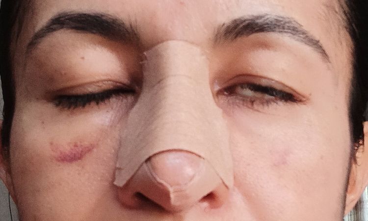 Despues de una Rinoplastia sr me queda un ojo medio abierto - 69030