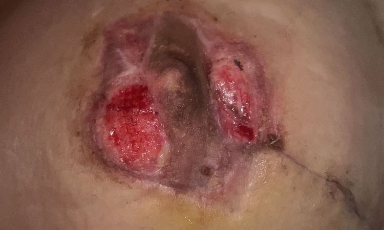 Injerto de piel en pezón - 69333