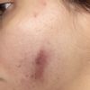 Marcas oscuras tras Dermapen y grietas