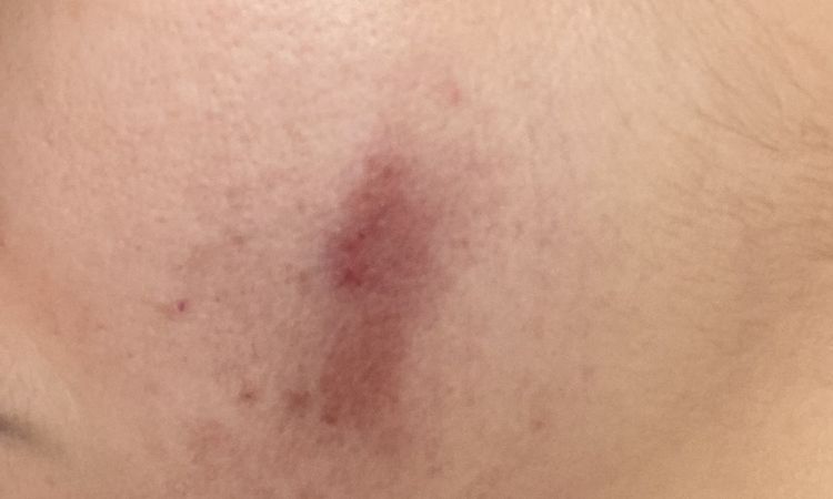 Marcas oscuras tras Dermapen y grietas - 69526