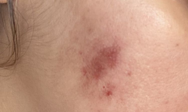 Marcas oscuras tras Dermapen y grietas - 69528