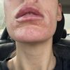 Infección impétigo al poner ácido hialuronico en labios.