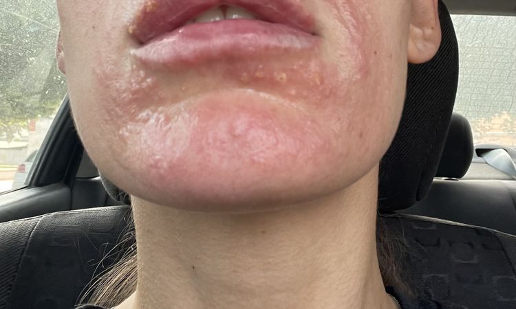 Infección impétigo al poner ácido hialuronico en labios. - 69661