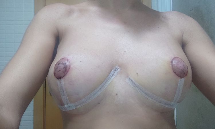 Cicatrices mastopexia por encima del surco mamario - 70248