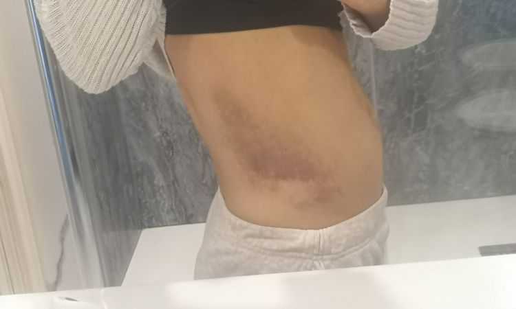 Moretones en el cuerpo después de mastopexia - 70338