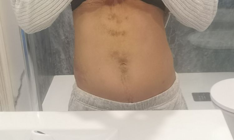 Moretones en el cuerpo después de mastopexia - 70339