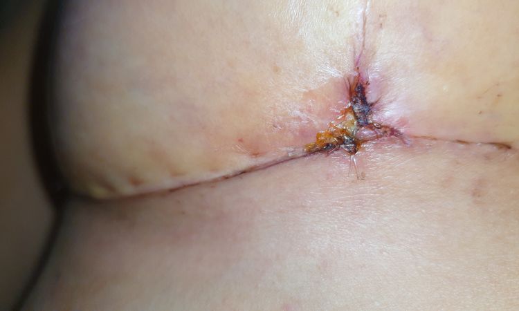 Puntos, sutura mastopexia con implantes - 70351