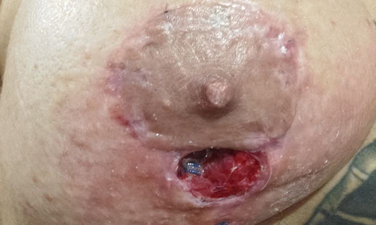 Mastopexia y herida abierta - 70782