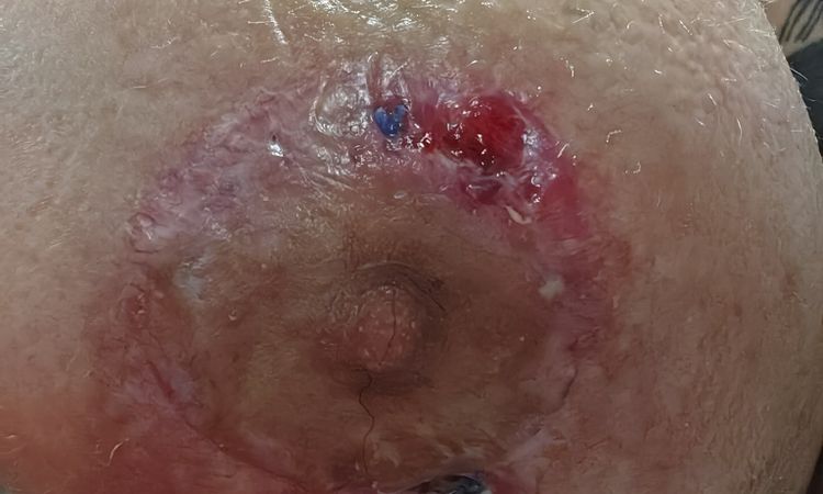 Mastopexia y herida abierta - 70783