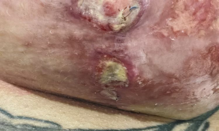 Mastopexia y herida abierta - 70784
