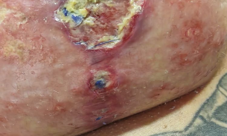 Mastopexia y herida abierta - 70785