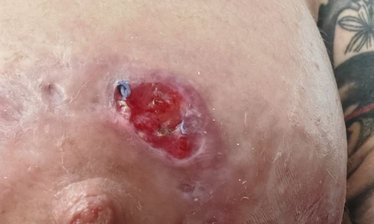 Mastopexia y herida abierta - 70786