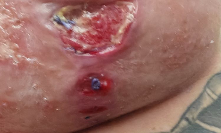 Mastopexia y herida abierta - 70787
