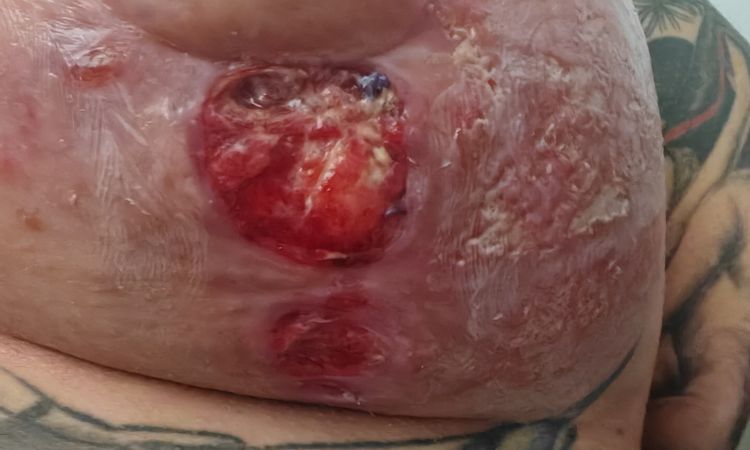 Mastopexia y herida abierta - 70788