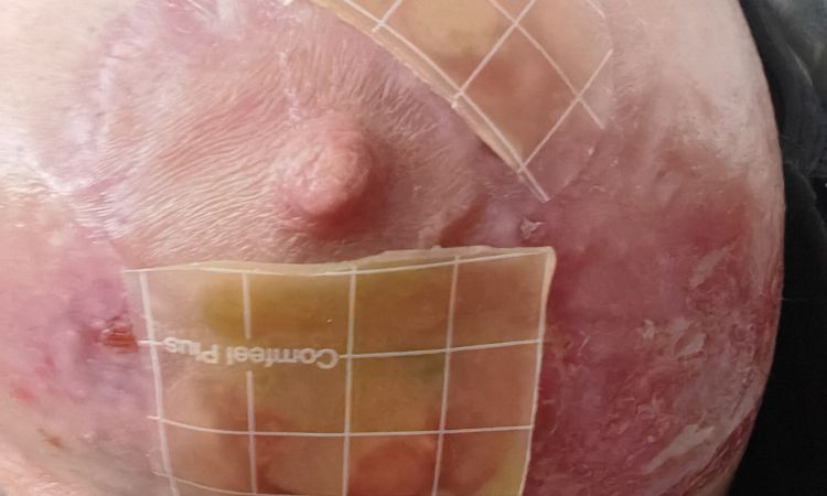 Mastopexia y herida abierta - 70789