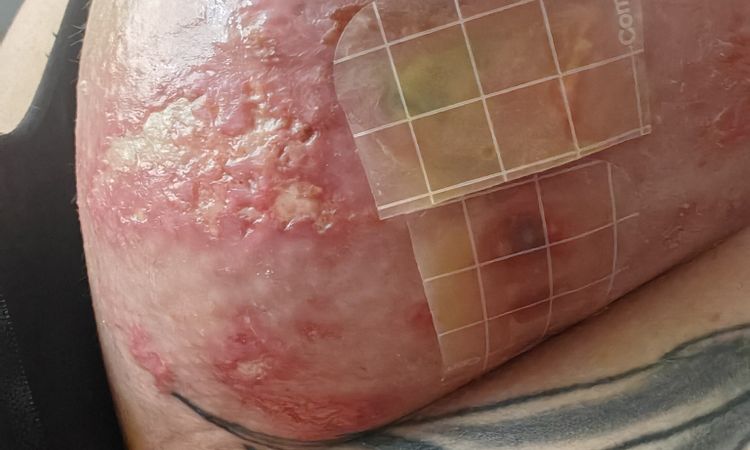 Mastopexia y herida abierta - 70790