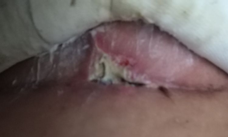 Maxtopexia con herida abierta - 71751