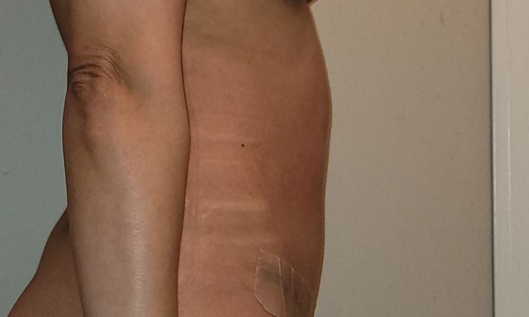 Es normal que el estomago se vea asi despues de una mini abdominoplastia? - 71816