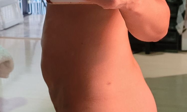 Es normal que el estomago se vea asi despues de una mini abdominoplastia? - 71819
