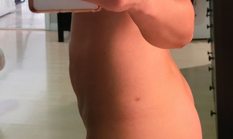 Es normal que el estomago se vea asi despues de una mini abdominoplastia? - 71820