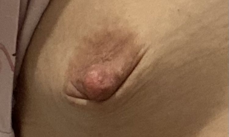 Pliegues areolas tras mamoplastia periareolar - 71827