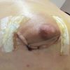 Pliegues areolas tras mamoplastia periareolar