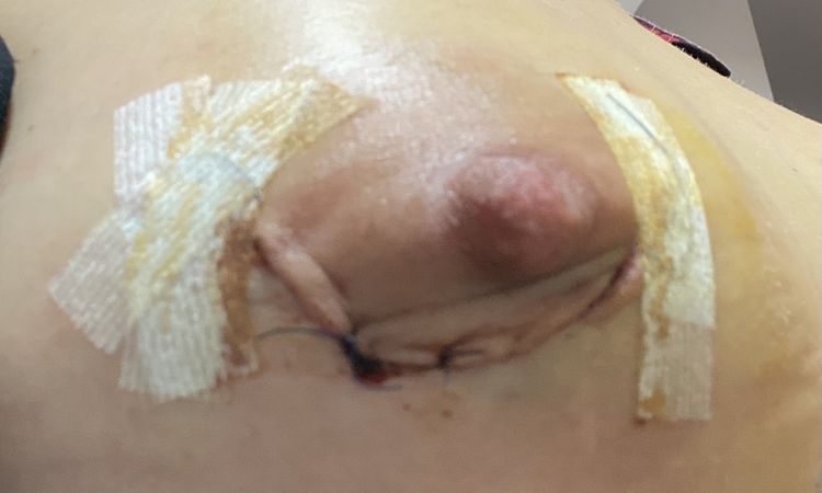 Pliegues areolas tras mamoplastia periareolar - 71828