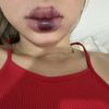 Hematomas hinchazon y endurecimiento relleno de labios