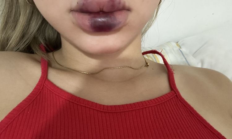 Hematomas hinchazon y endurecimiento relleno de labios - 72367