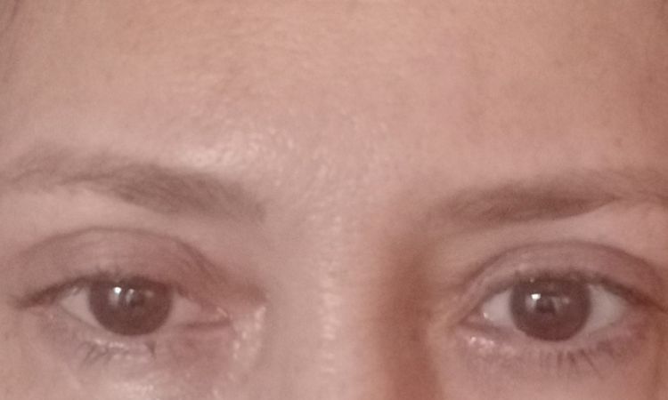 Post blefaroplastia superior - 72477