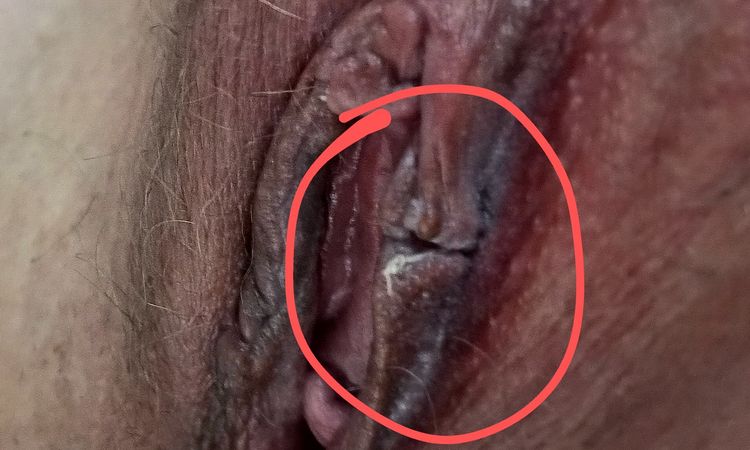 Labioplastia hace 3 semanas - 72748