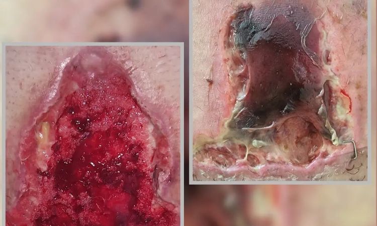 Es normal que te hagan esto en una abdominoplastia. - 73179