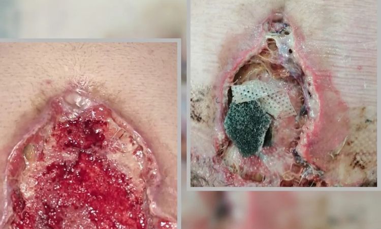 Es normal que te hagan esto en una abdominoplastia. - 73180