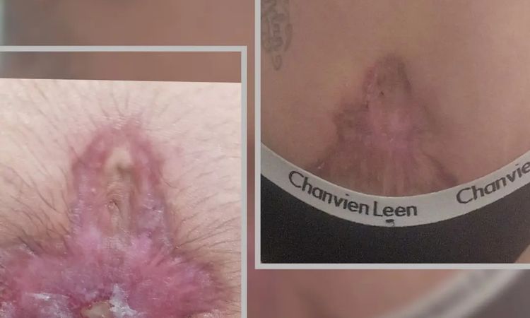 Es normal que te hagan esto en una abdominoplastia. - 73181