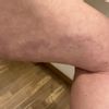 Lipovaser marcas muslos y tacto raro