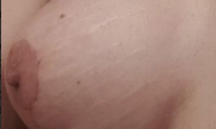Malos resultados después de un retoque de pecho - 74084