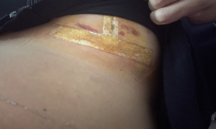 Quemazón e inflamación cicatriz mastopexia - 74527