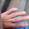 Tengo los dedos de las manos deformes por artrosis es posible corregirlos? - 74546