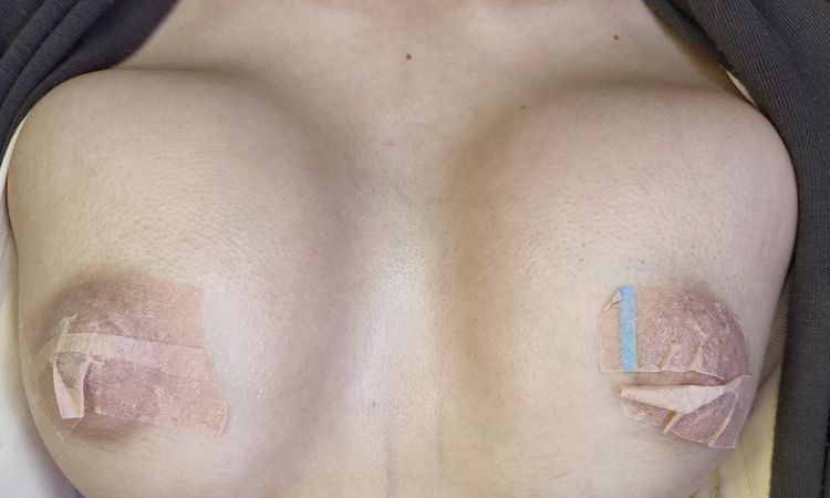 Pechos cuadrados (sin mastopexia) - 74984