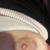 Cicatriz irregular tras reducción de areola