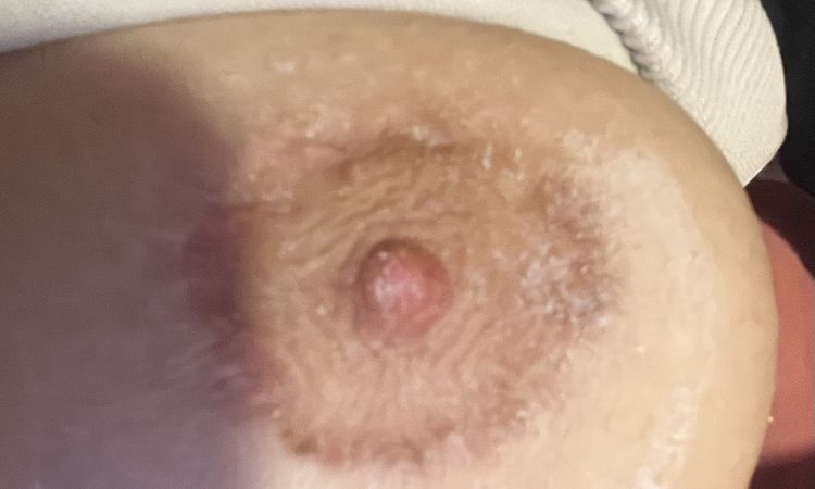 Cicatriz irregular tras reducción de areola - 75095