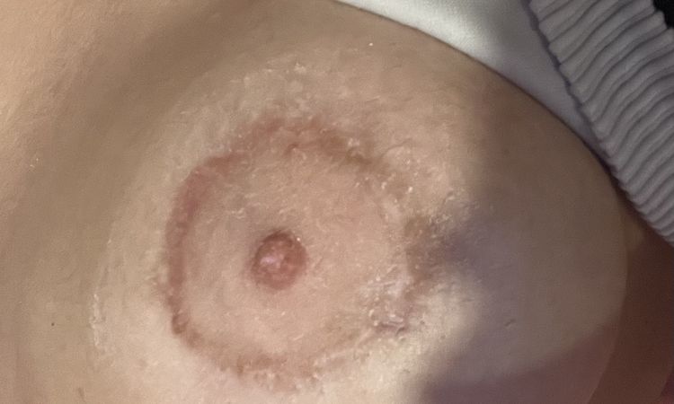 Cicatriz irregular tras reducción de areola - 75096