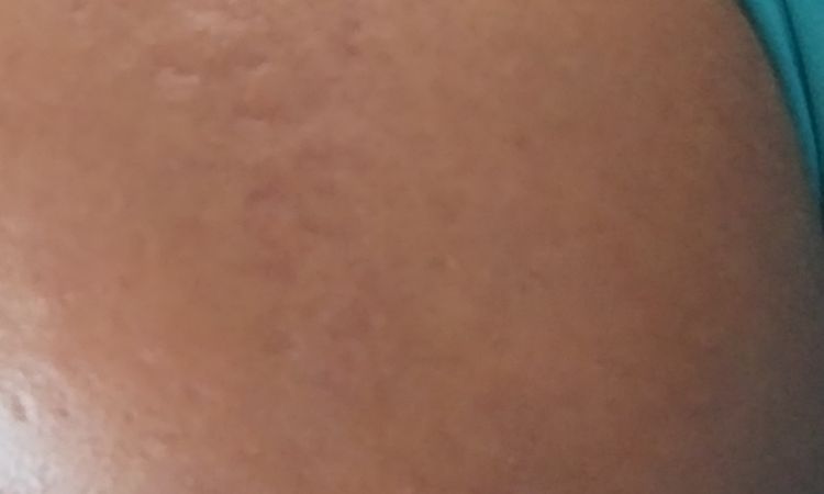 Peeling TCA tricloroacético - 75380