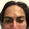 Que Tipos de tratamiento para la rosacea hay ?