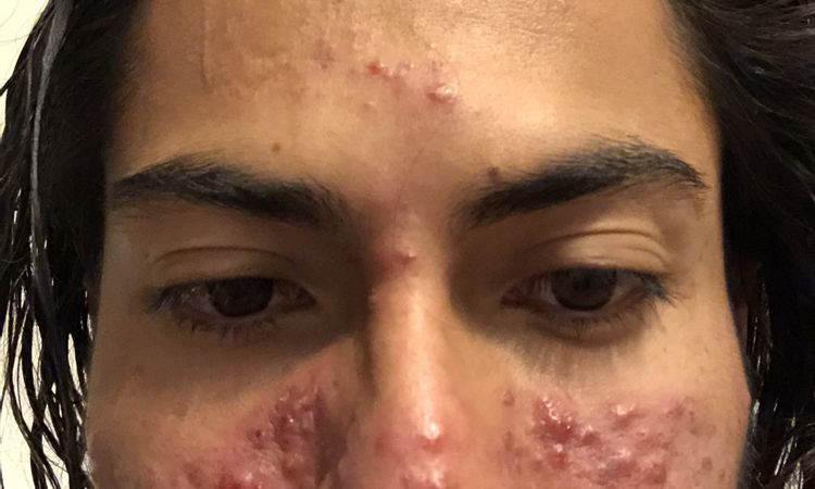 Que Tipos de tratamiento para la rosacea hay ? - 76453
