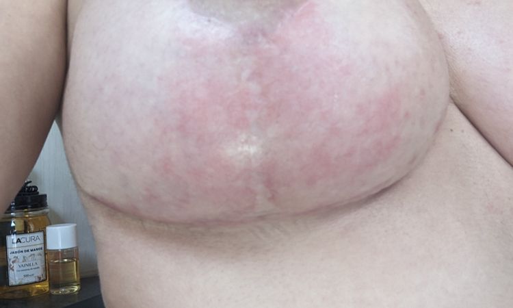 Pecho rojo tras mastopexia después de 3 meses casi - 76482