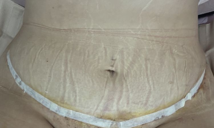 ¿Cuándo es seguro que ningún punto se abrirá en una abdominoplastia? - 77301