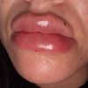 Labios con acido demasiada inflamación