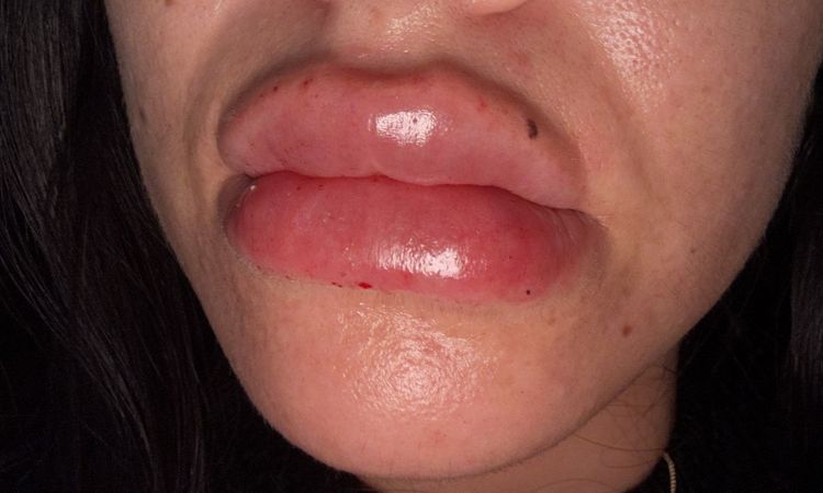 Labios con acido demasiada inflamación - 77303